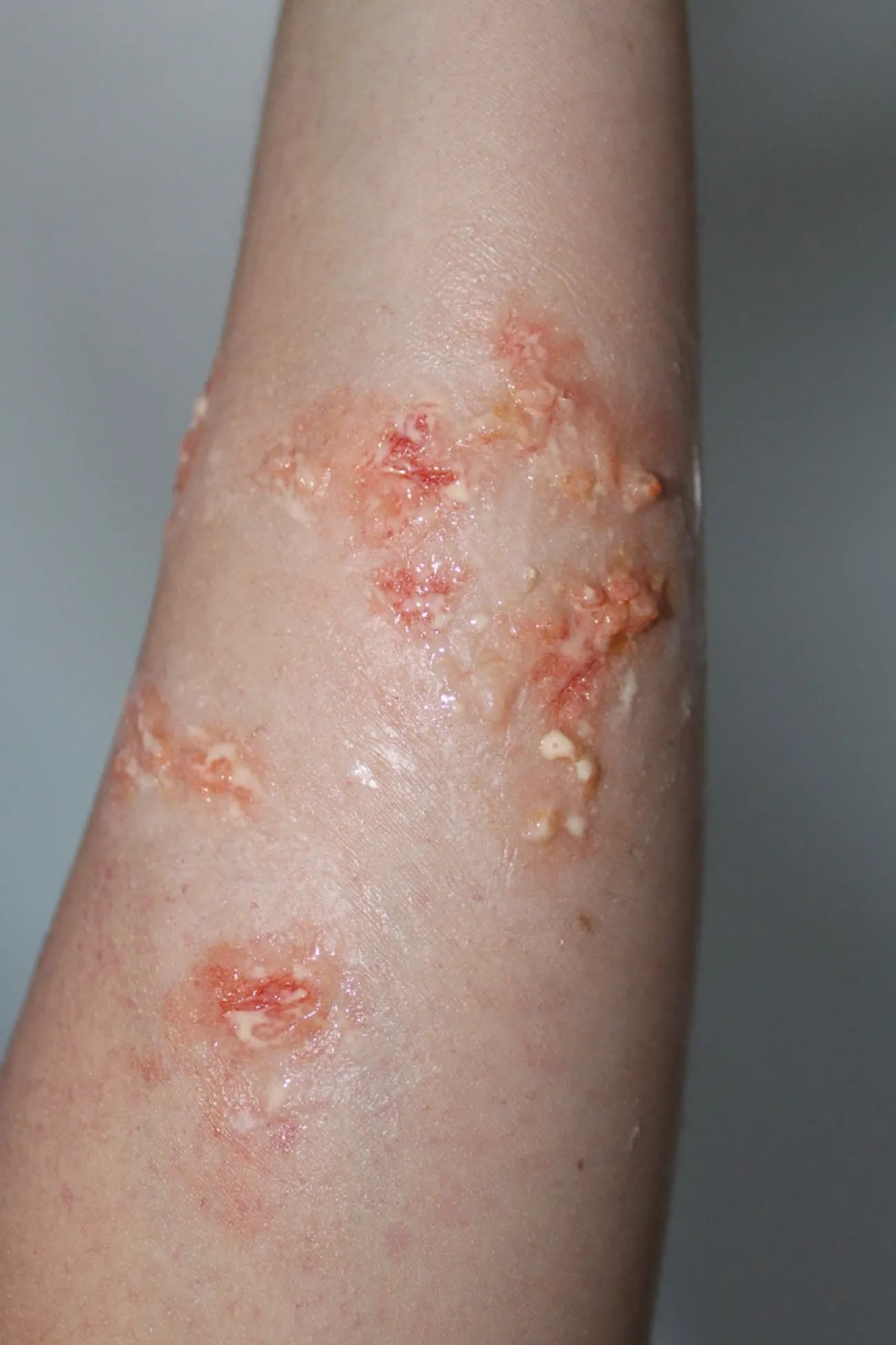 ForensicFX Studios Infected Blisters / Boils Prosthetic> Halloween Accessories