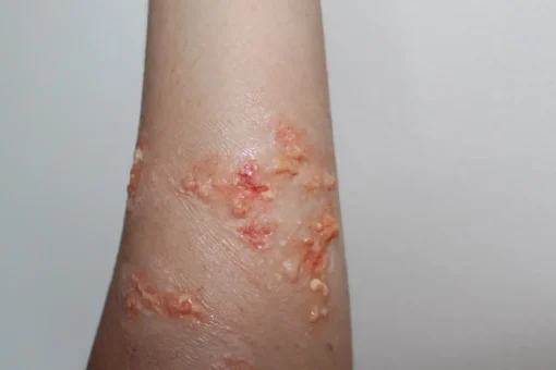 ForensicFX Studios Infected Blisters / Boils Prosthetic> Halloween Accessories