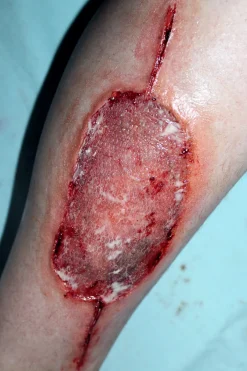 ForensicFX Studios Infected Medical Skin Graft Prosthetic></noscript> Halloween Accessories