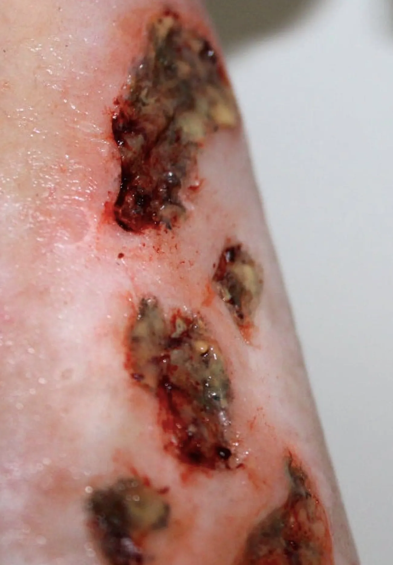 ForensicFX Studios Infected Wound / Burn Prosthetic> Halloween Accessories