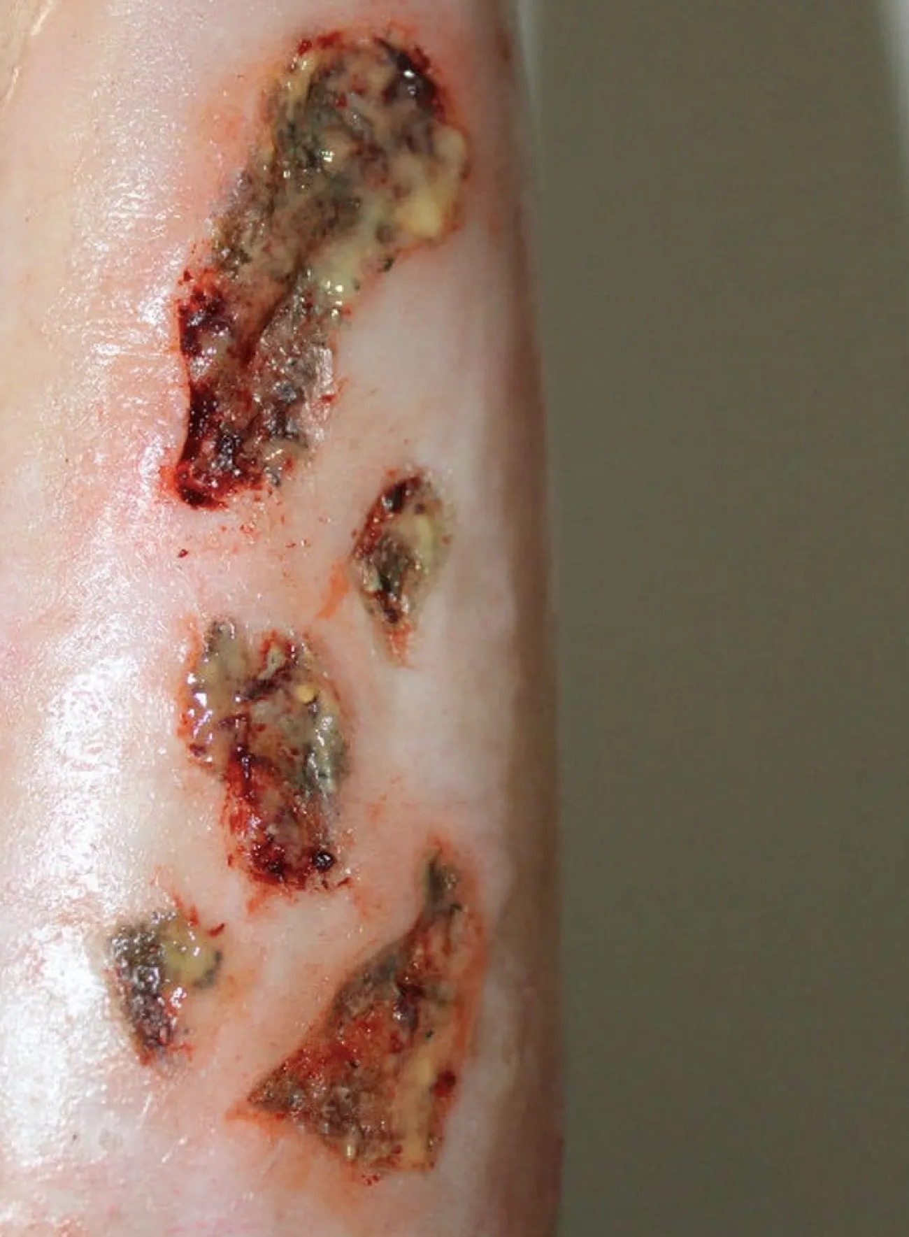 ForensicFX Studios Infected Wound / Burn Prosthetic> Halloween Accessories