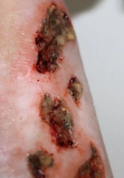 ForensicFX Studios Infected/Burn Wound Prosthetics Bundle></noscript> Halloween Accessories