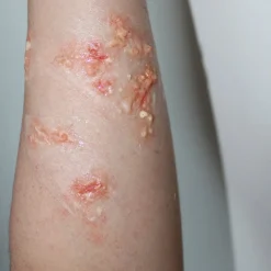 ForensicFX Studios Infected/Burn Wound Prosthetics Bundle></noscript> Halloween Accessories