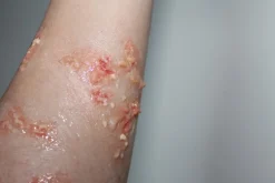 ForensicFX Studios Infected/Burn Wound Prosthetics Bundle></noscript> Halloween Accessories