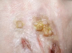 ForensicFX Studios Infected/Burn Wound Prosthetics Bundle></noscript> Halloween Accessories