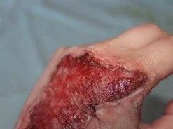 ForensicFX Studios Skin Burn Prosthetic></noscript> Halloween Accessories