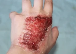 ForensicFX Studios Skin Burn Prosthetic></noscript> Halloween Accessories